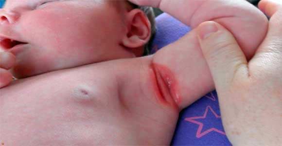 Bolalarda terining bichilishi (qizarishi)